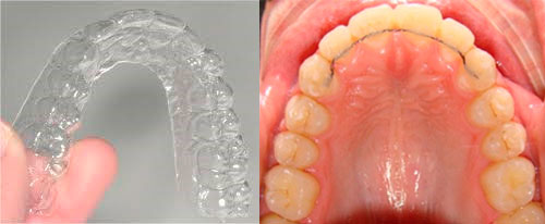 ferula-dientes-Copy